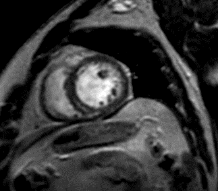 CARDIAC SARCOIDOSIS